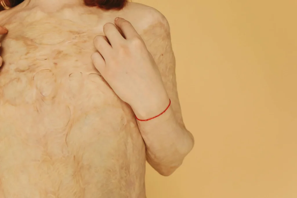 A person's upper body with scarred skin against a beige background, embracing the journey of loving myself. A red string bracelet is on their wrist.